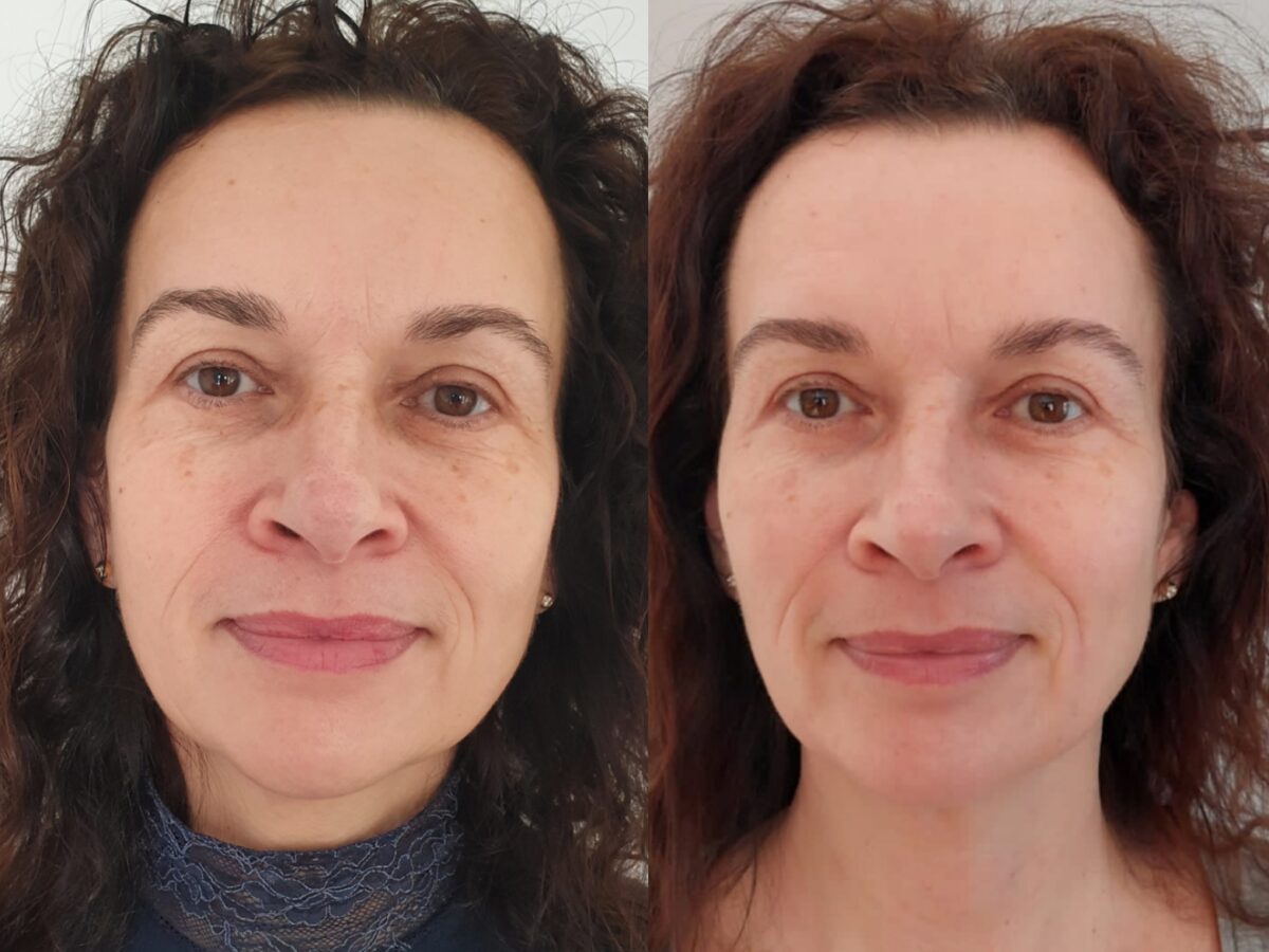 REJUVENARE FACIALĂ CU LASER CO2